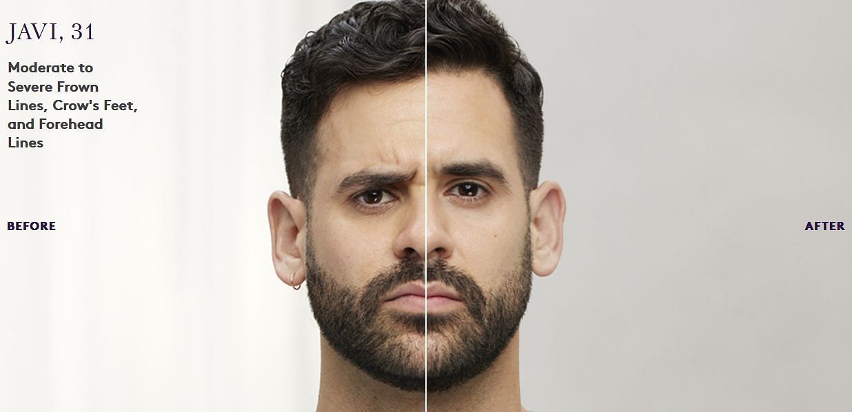 Javi, 31 years, looks much younger than his previous photos (Image via Botox Cosmetic)